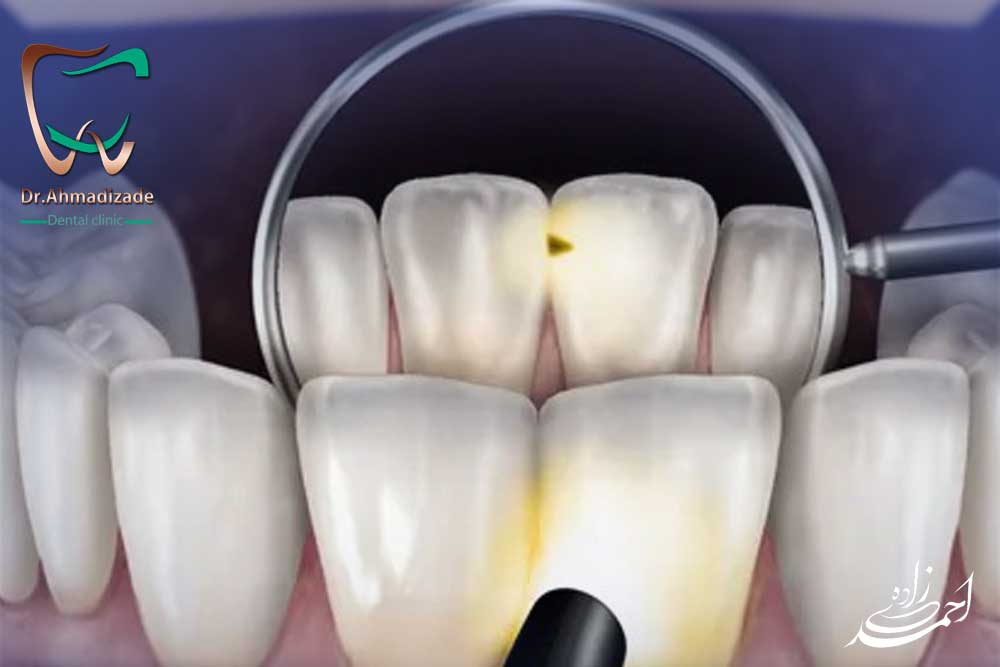 Tooth Decay2