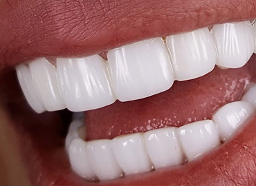 کامپوزیت دندان