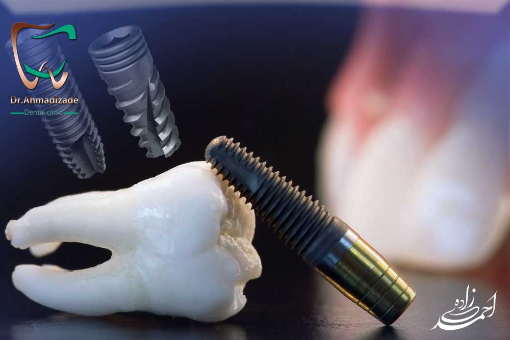 بهترین ایمپلنت دندان چه برندی است
