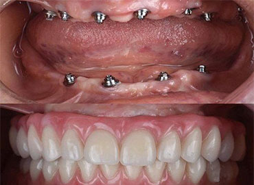 ایمپلنت دندان قیمت و هزینه ایمپلنت