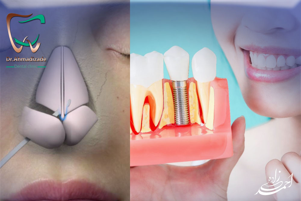 Nose surgery and dental implants2