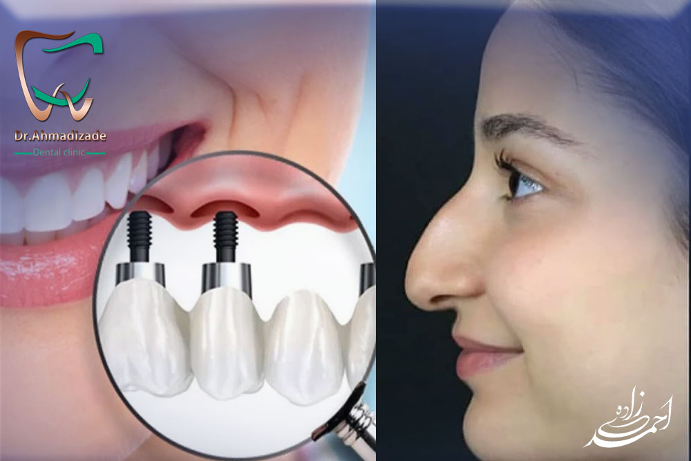 Nose surgery and dental implants3