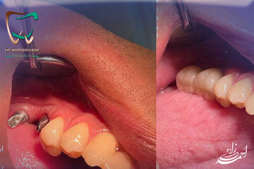 مزایای ایمپلنت | توانایی ایمپلنت در حفظ زیبایی