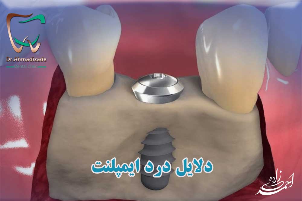درد ایمپلنت دندان