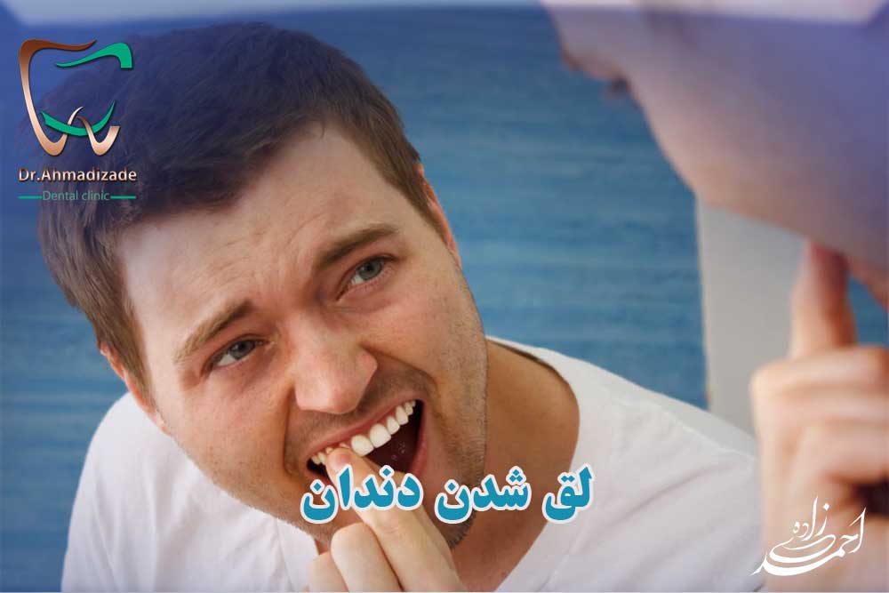 لق شدن دندان چه دلایلی دارد