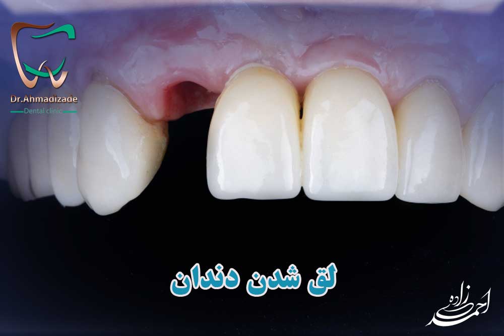 لق شدن دندان چه دلیلی دارد