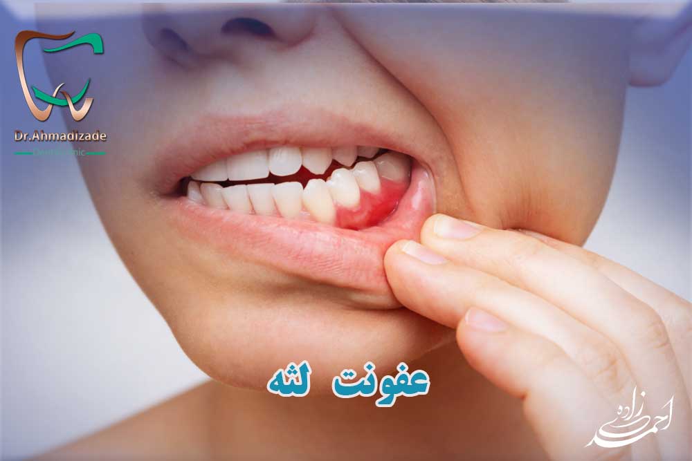 عفونت دهان و عفونت لثه ها