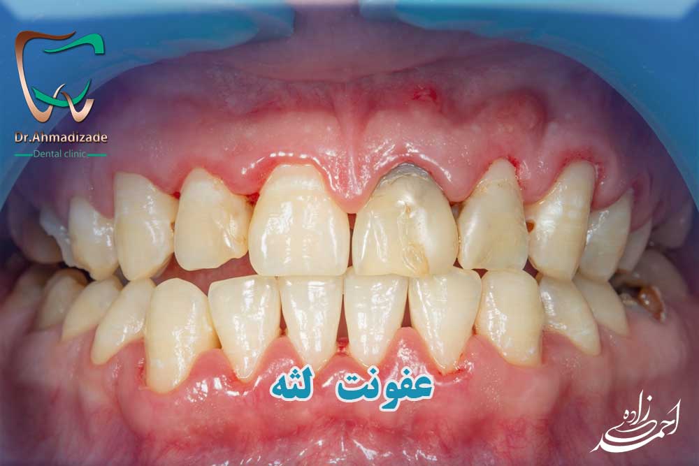 عفونت لثه - عفونت لثه دندان