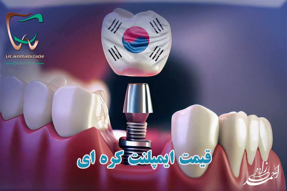 قیمت ایمپلنت کره ای در تهران