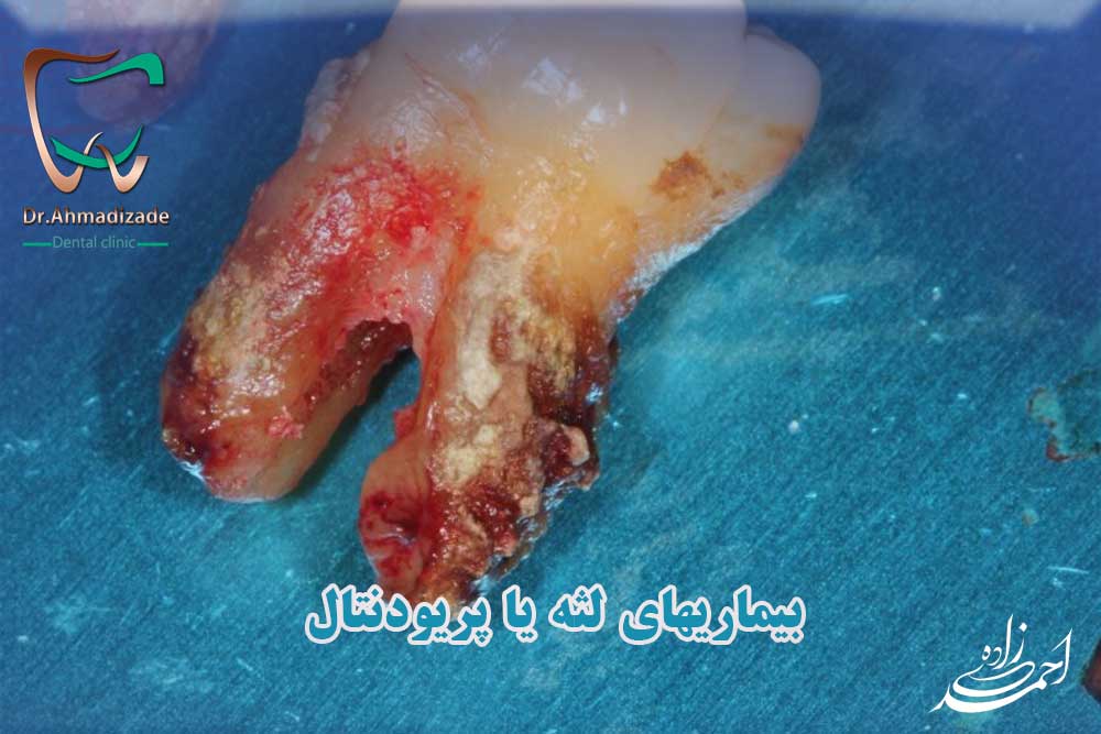 بیماری های لثه و پریودنتال