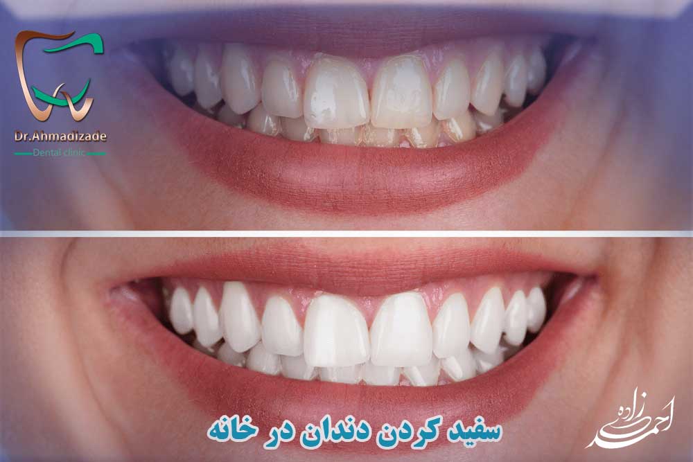 سفید کردن دندان در خانه - زیبایی دندان در خانه