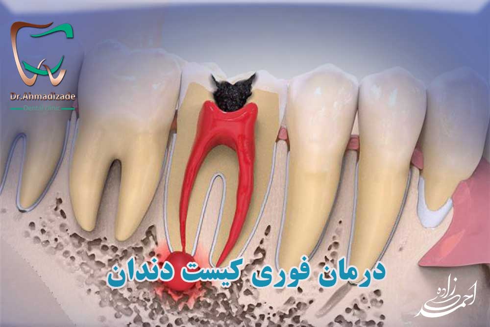 درمان فوری کیست دندان
