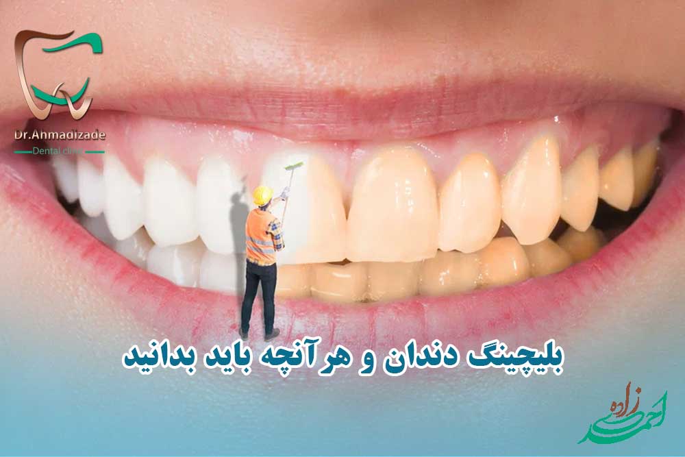 بلیچینگ دندان قیمت و هزینه
