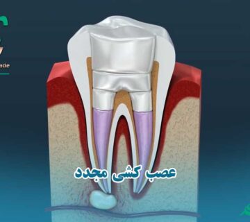 عصب کشی مجدد یا ری اندو چیست