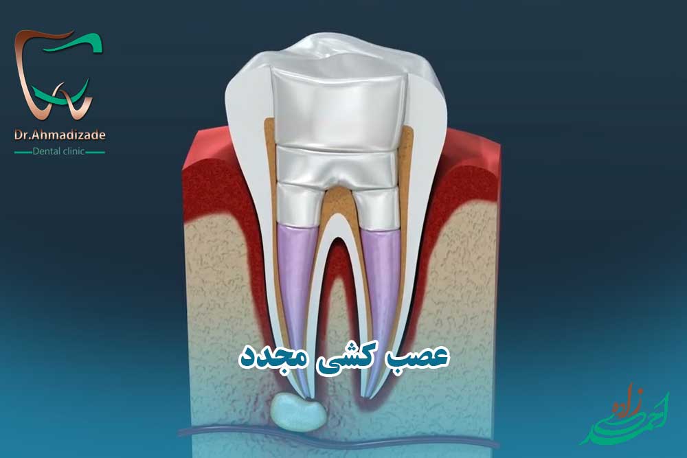 عصب کشی مجدد یا ری اندو چیست