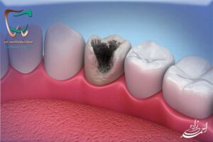 پوسیدگی دندانی