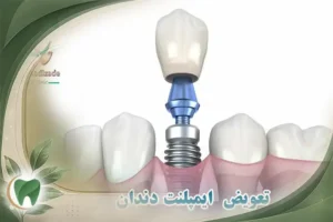 تعویض ایمپلنت دندان