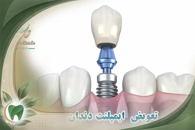 تعویض ایمپلنت دندان