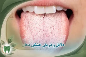 خشکی دهان یا زروستومیا