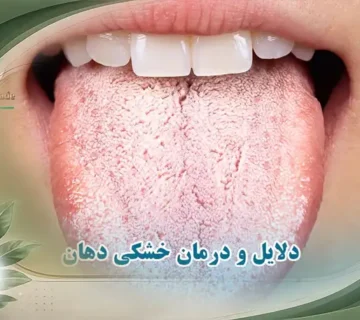 خشکی دهان یا زروستومیا