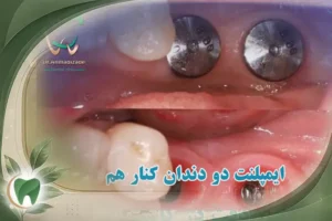 ایمپلنت دو دندان کنار هم