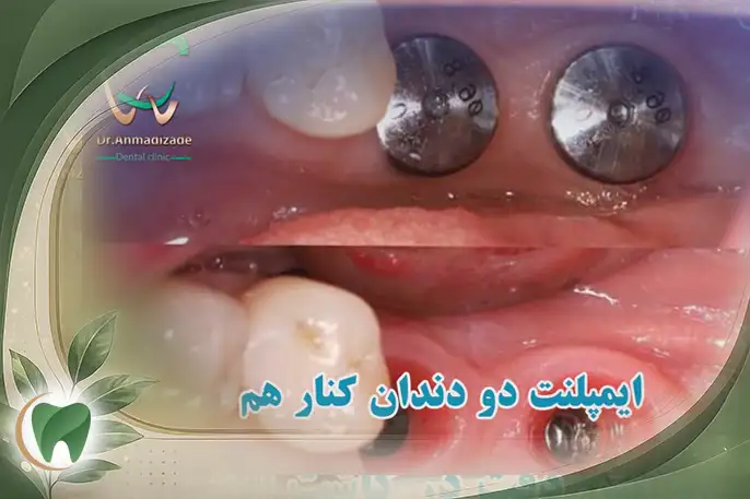 ایمپلنت دو دندان کنار هم