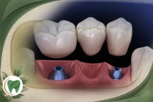 بهترین روکش برای ایمپلنت دندان و انواع آن
