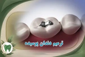 ترمیم دندان های پوسیده