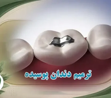ترمیم دندان های پوسیده