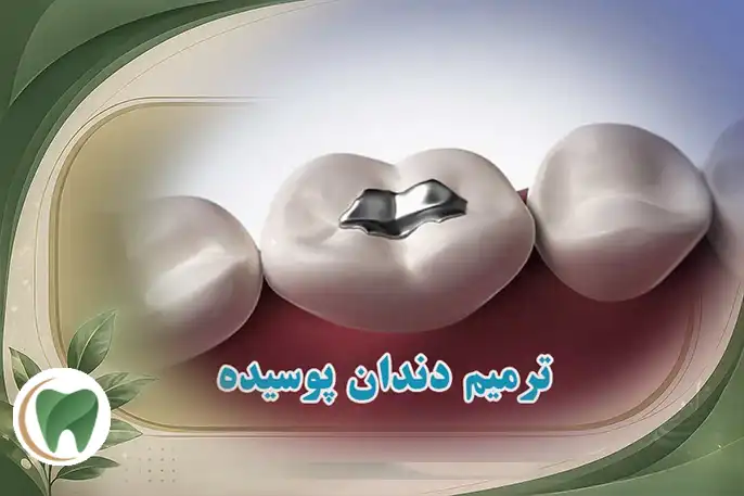 ترمیم دندان های پوسیده