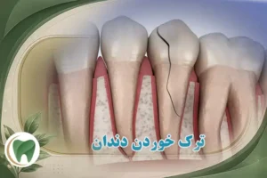 ترک خوردن دندان