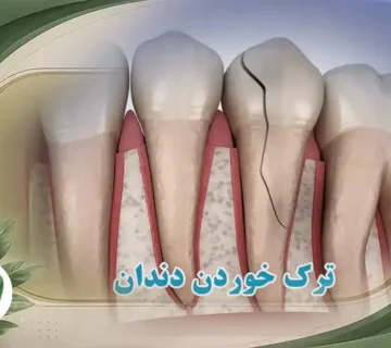 ترک خوردن دندان