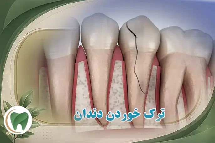 ترک خوردن دندان