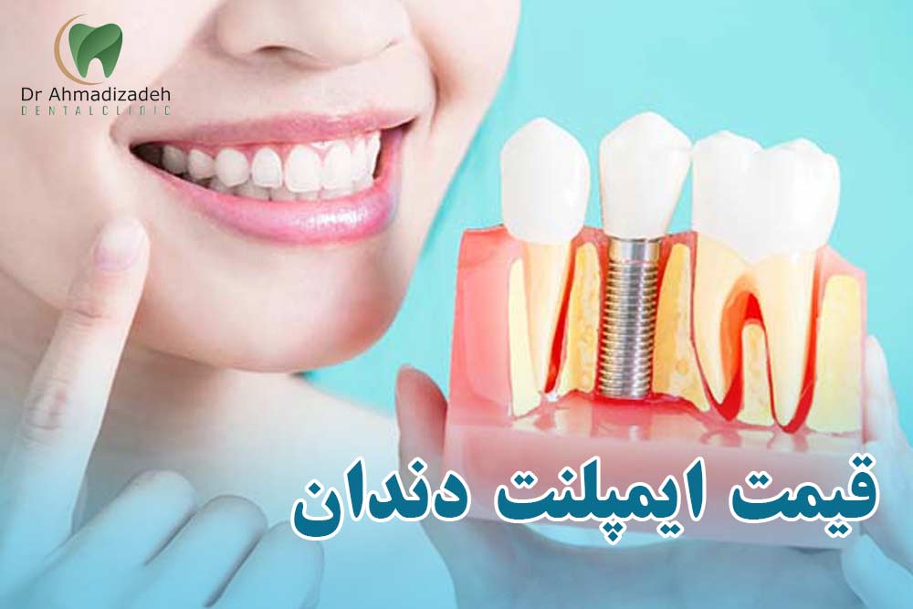 قیمت ایمپلنت دندان فک بالا