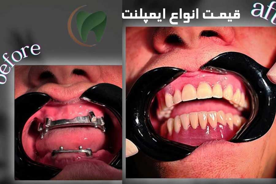 قیمت ایمپلنت در تهران با تخفیف