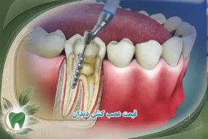 قیمت عصب کشی دندان ها  