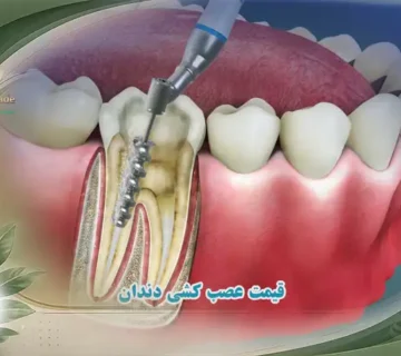قیمت عصب کشی دندان ها  