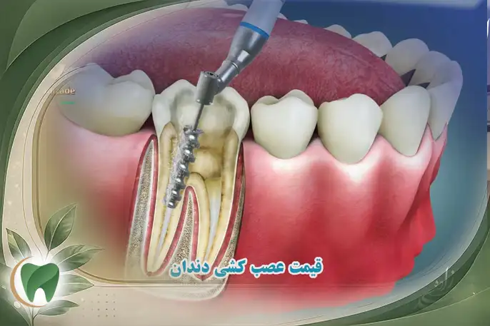 قیمت عصب کشی دندان ها  