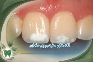 لکه سفید روی دندان