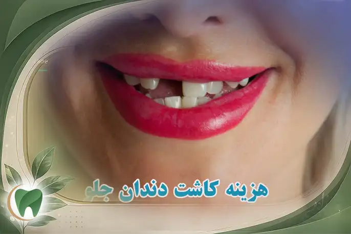 هزینه کاشت دندان جلو