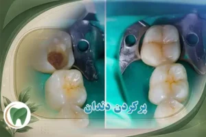 پرکردن دندان قیمت