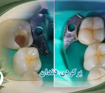 پرکردن دندان قیمت