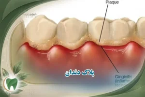 پلاک دندان چیست