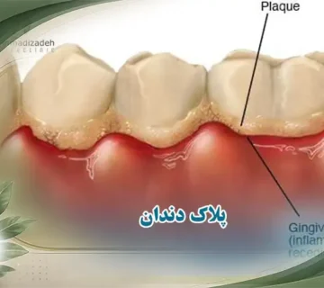 پلاک دندان چیست