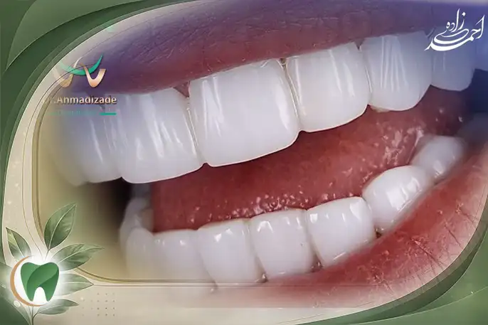 کامپوزیت دندان در قیطریه