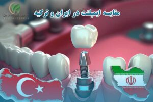 قیمت ایمپلنت دندان در ایران و ترکیه مقایسه ۱۴۰۴-2025