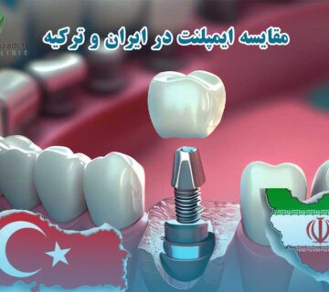 قیمت ایمپلنت دندان در ایران و ترکیه مقایسه ۱۴۰۴-2025