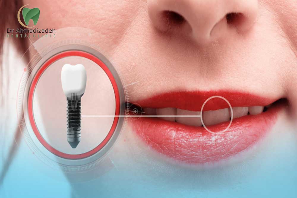 ایمپلنت ترکیه5