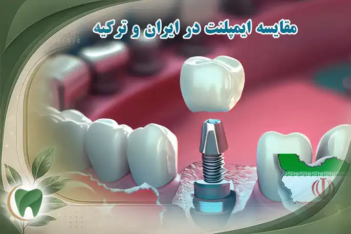 قیمت ایمپلنت دندان در ایران و ترکیه