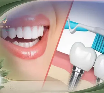 مراقبت از ایمپلنت دندان پس از جراحی